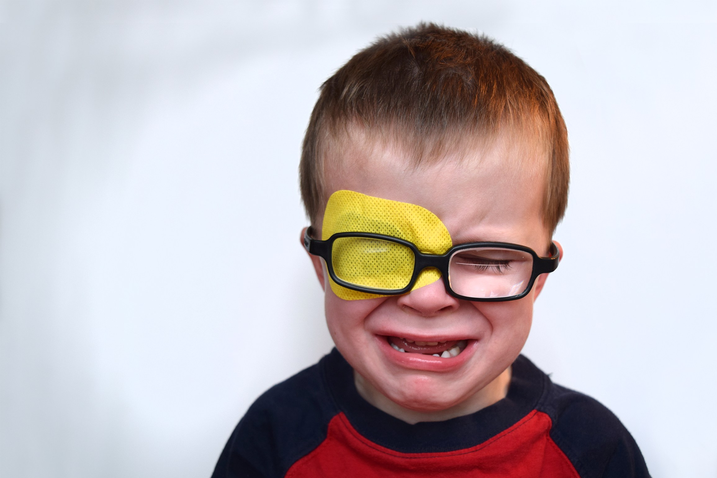 Researchers claim that "lazy eye" rewires the brain to alter the vision