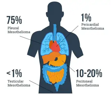 If you have been diagnosed with adenocarcinoma cancer, you have a cancer that developed in one of the glands that lines the inside of your organs. Things You Need To Know About Mesothelioma Cancer A Rare Cancer