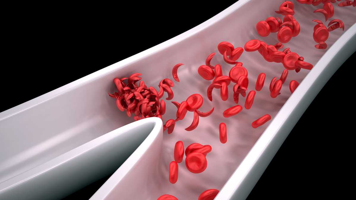 sickle-cell-anemia-and-malaria-simplebiol